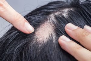 Alopecia