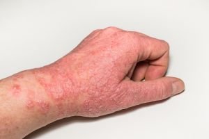 Eczema